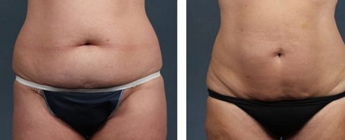 coolsculpting 1 elite beauty toledo