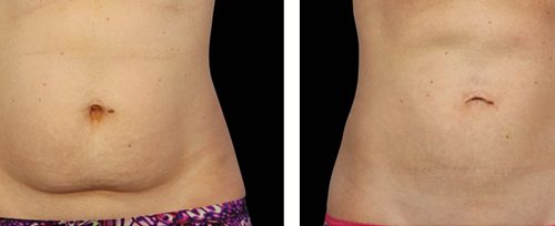 coolsculpting 2 elite beauty toledo