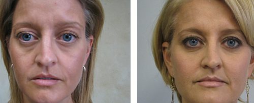 facial rejuvenation 5 elite beauty toledo