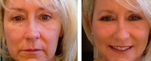facial rejuvenation elite beauty toledo 4