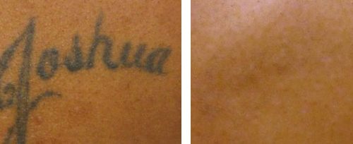 laser tattoo removal 1 elite beauty toledo