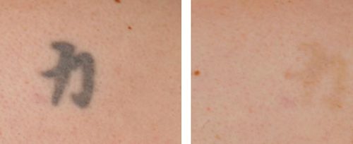 laser tattoo removal elite beauty toledo