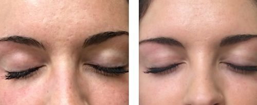 microneedling 1 elite beauty toledo