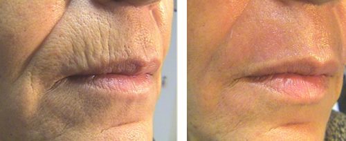 microneedling 2 elite beauty toledo