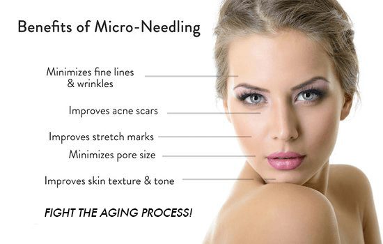 microneedling