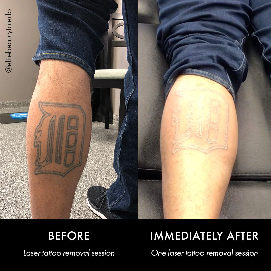 Black Tattoo Removal (Before/After 6 sessions) | Laser tattoo removal, New  tattoos, Tattoo removal cost