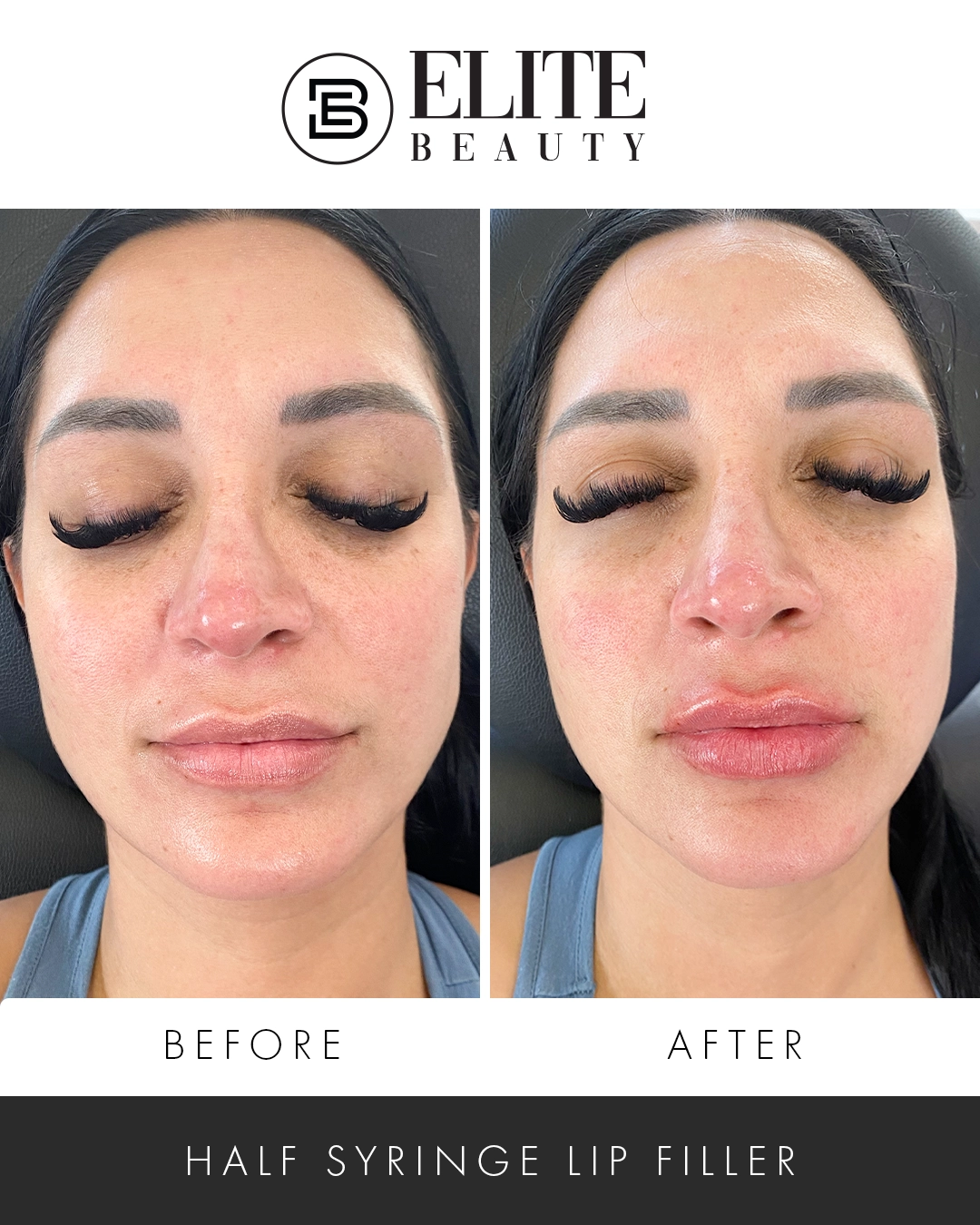 EB Brittany Before After Lip Filler Toledo Ohio copy